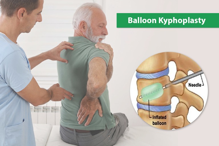 balloon kyphoplasty